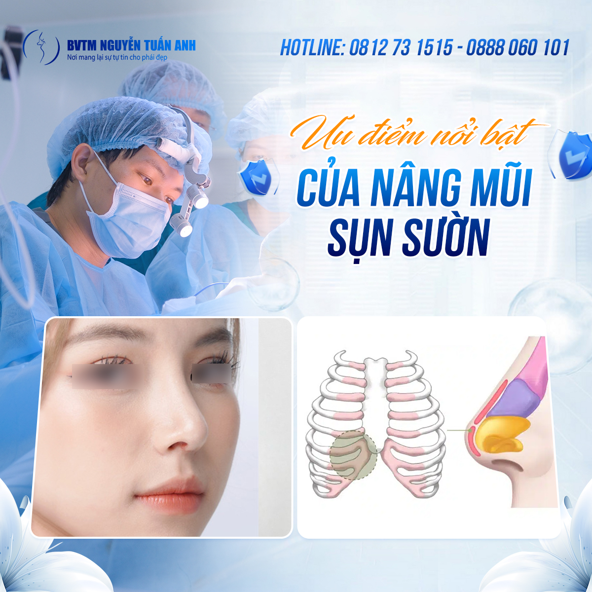 Nâng mũi sụn sườn có bền lâu không